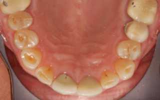 Как лечить кариес в домашних условиях