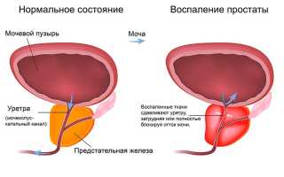 Питание при аденоме простаты у мужчины и после операции