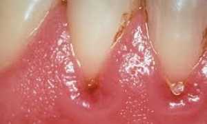 Вред зубного камня