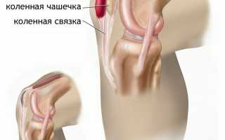 Опухоль в колене: избавляемся от боли народными средствами