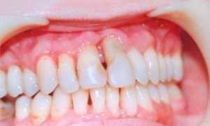 Генерализованная форма пародонтита: этиология, степени, симптомы, методы лечения