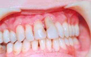 Генерализованная форма пародонтита: этиология, степени, симптомы, методы лечения