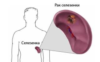 Рак селезёнки: симптомы и лечение