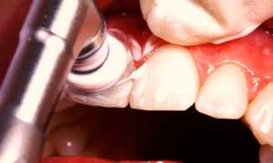 Ультразвуковое отбеливание зубов