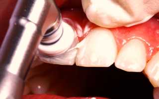 Ультразвуковое отбеливание зубов