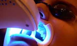 Чистка зубного камня