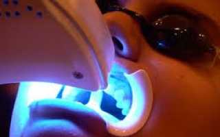 Чистка зубного камня