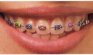 От чего зависит стоимость брекетов?