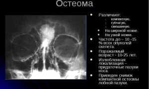 Остеома лобной пазухи
