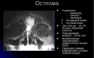 Остеома лобной пазухи