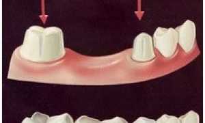 Виды протезирования зубов. Какой вид протезирования лучше?