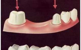 Виды протезирования зубов. Какой вид протезирования лучше?