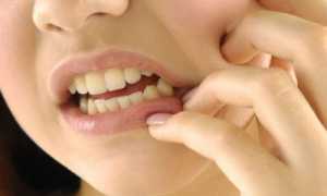 Можно ли обойтись без стоматолога: удаление зубного камня в домашних условиях