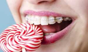 Брекеты Damon Clear: преимущества и недостатки