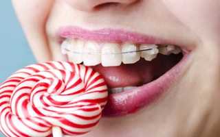 Брекеты Damon Clear: преимущества и недостатки