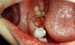 Как опознать у себя пульпит и что будет, если его не лечить?