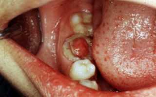 Как опознать у себя пульпит и что будет, если его не лечить?