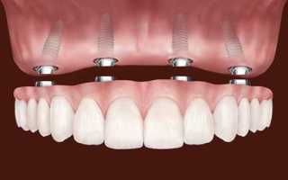 Протезирование при полном отсутствии зубов