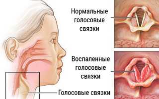 Симптомы фибромы голосовой связки