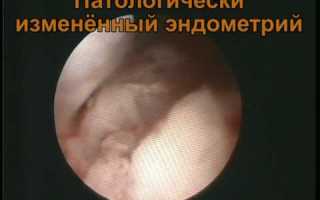 Рак эндометрия: симптомы и лечение