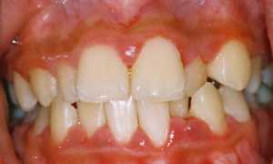 Гипертрофический гингивит: этиология, симптоматика, методы лечения