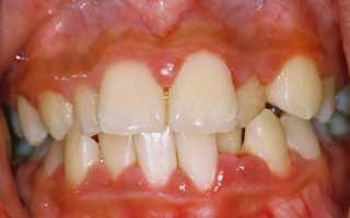 Гипертрофический гингивит: этиология, симптоматика, методы лечения