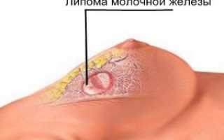 Липома молочной железы может ли быть раком?