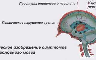 Симптомы и лечение саркомы головного мозга
