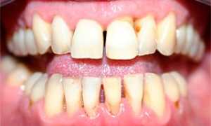 Хронический пародонтит: особенности течения, этиология, симптоматика, классификация, методы лечения и профилактики