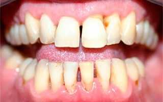 Хронический пародонтит: особенности течения, этиология, симптоматика, классификация, методы лечения и профилактики