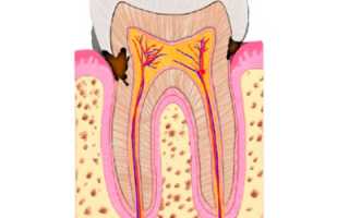 Лучший способ лечения – предупредить развитие болезни! Виды кариеса зубов