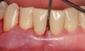 Какие самые эффективные методики лечения пародонтоза существуют в наше время?