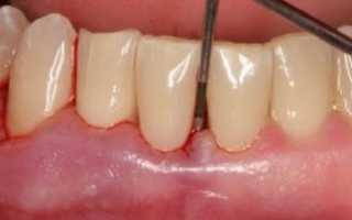 Какие самые эффективные методики лечения пародонтоза существуют в наше время?