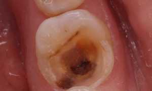 Воспаление пульпита: симптомы, причины, диагностика и лечение