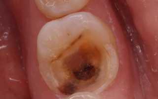 Воспаление пульпита: симптомы, причины, диагностика и лечение