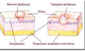Мягкая и твёрдая фиброма кожи