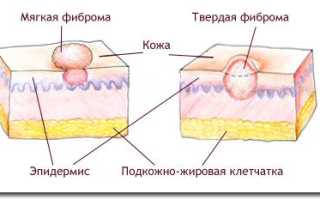 Мягкая и твёрдая фиброма кожи