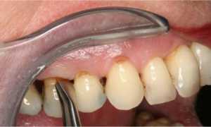 Что собой представляет хронический периодонтит: как распознать и вылечить болезнь?