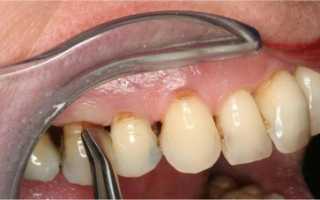 Что собой представляет хронический периодонтит: как распознать и вылечить болезнь?