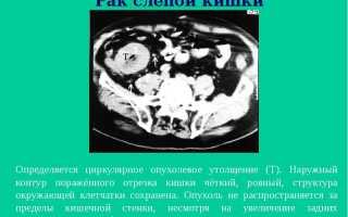 Симптомы и способы лечения рака слепой кишки