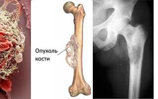 Причины появления саркомы кости, её стадии и лечение