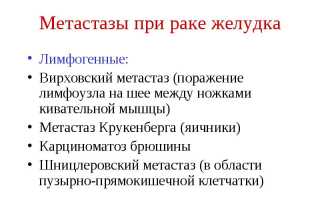 Метастаз Крукенберга: симптомы и лечение