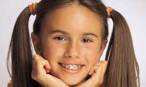 Брекеты для детей: особенности лечения и выбор брекетов