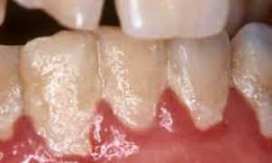 Начальный кариес