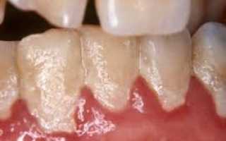 Начальный кариес