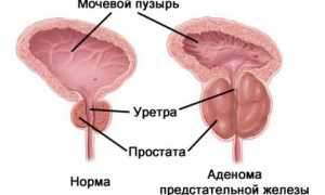 Профилактика аденомы простаты у мужчин