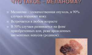 Родинка или меланома?