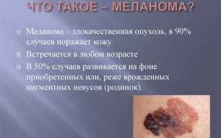Родинка или меланома?