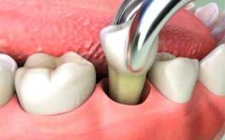 Экспертное мнение: через какое время после удаления зуба можно ставить новый?