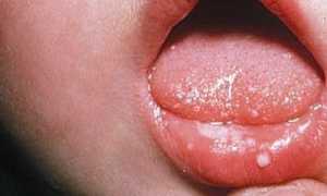 Грамотное лечение стоматита у детей: рекомендации, препараты, народные средства